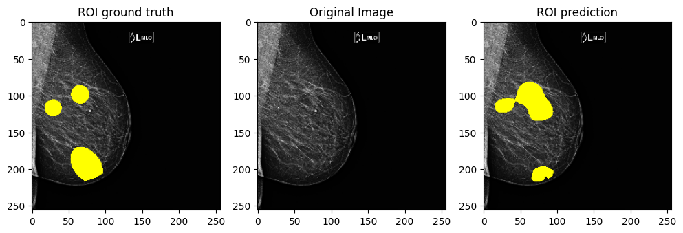 Semi-Supervised Mammography-Screening Tumor Detection's cover