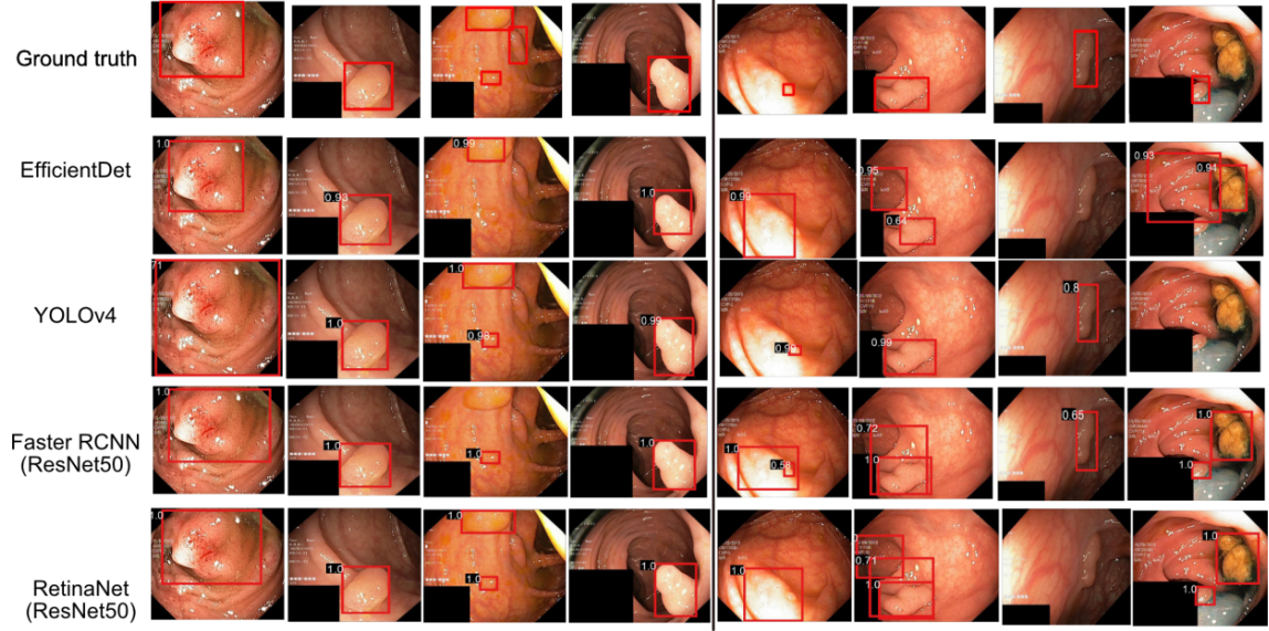Real-time automatic detection and classification of colorectal polyps during colonoscopy using Explainable AI's cover